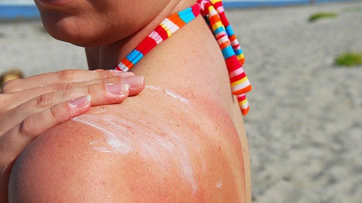 Jak rozpoznać, zapobiegać i leczyć alergię na filtry przeciwsłoneczne